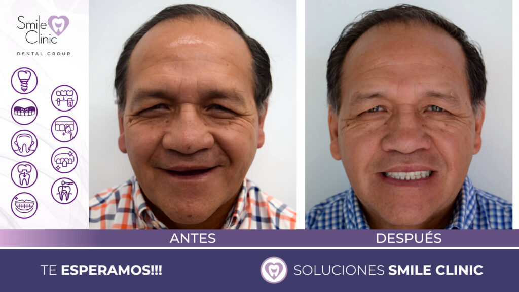 FOTOS ANTES Y DESPUES 2023.007