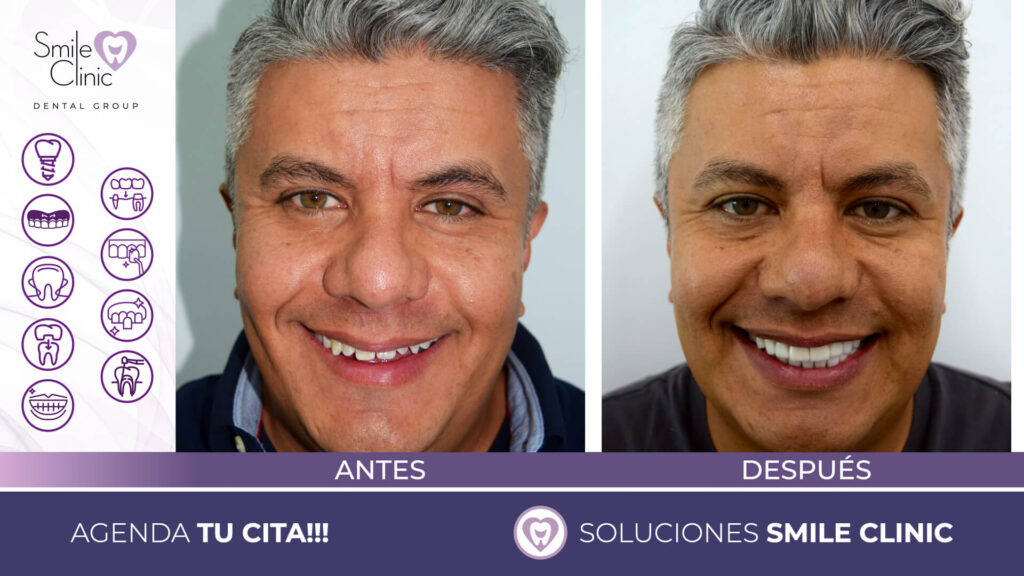 FOTOS ANTES Y DESPUES 2023.012