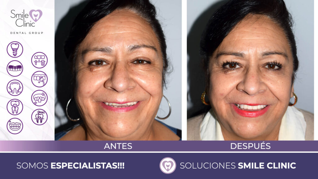 FOTOS ANTES Y DESPUES 2023.013